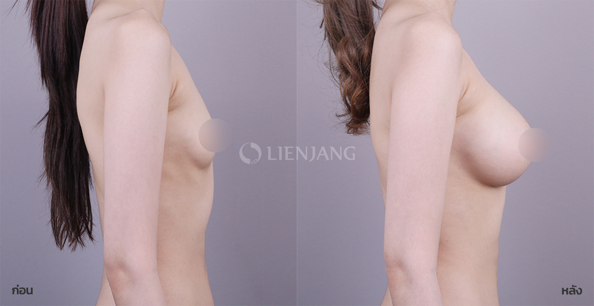 เสริมหน้าอก · หลังผ่าตัด 5 เดือน — Lienjang case #128