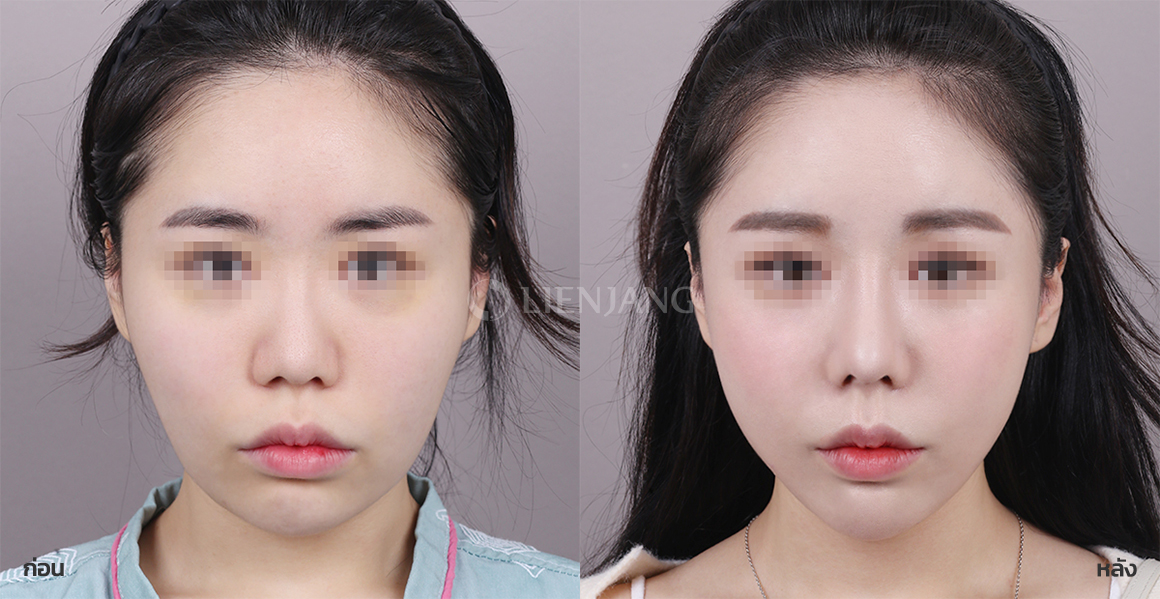 ศัลยกรรมโหนกแก้ม + ศัลยกรรมกราม · หลังผ่าตัด 1 เดือน — Lienjang case #103