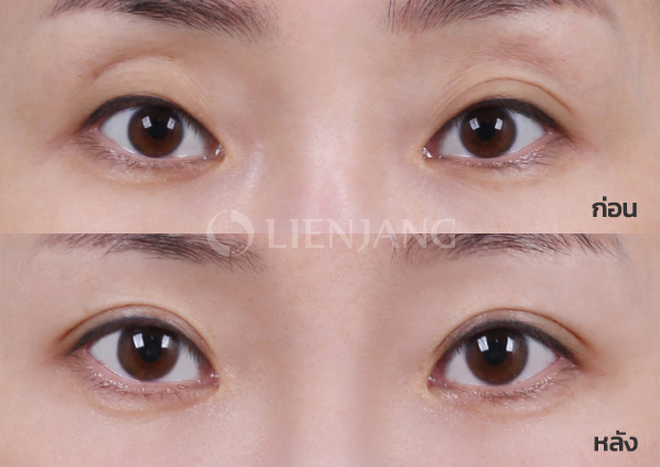 Natural-adhesion double eyelid · 5 months after surgery — Lienjang case #001
