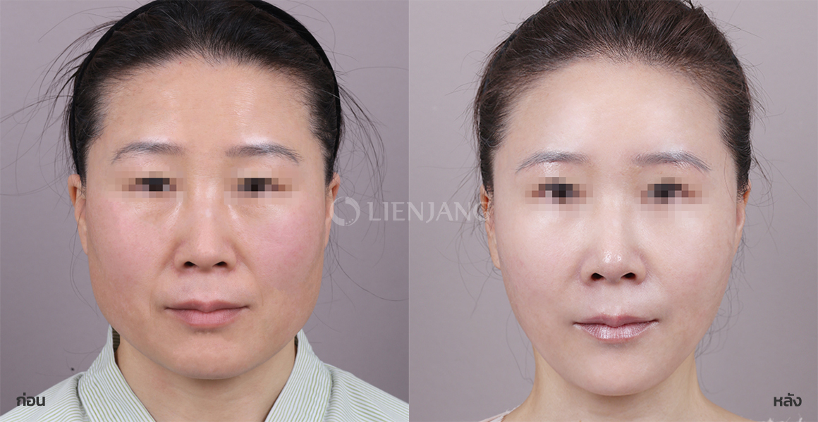Facial fat grafting · 5 months after surgery — Lienjang case #115