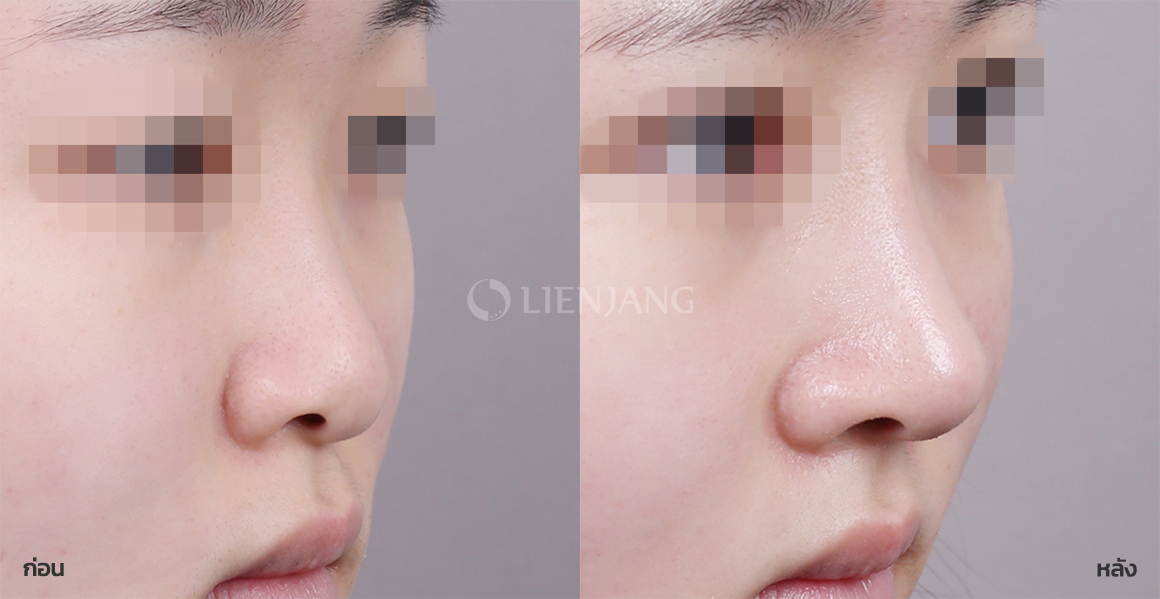 เสริมจมูก (สันจมูก + ปลายจมูก) · หลังผ่าตัด 1 เดือน — Lienjang case #064