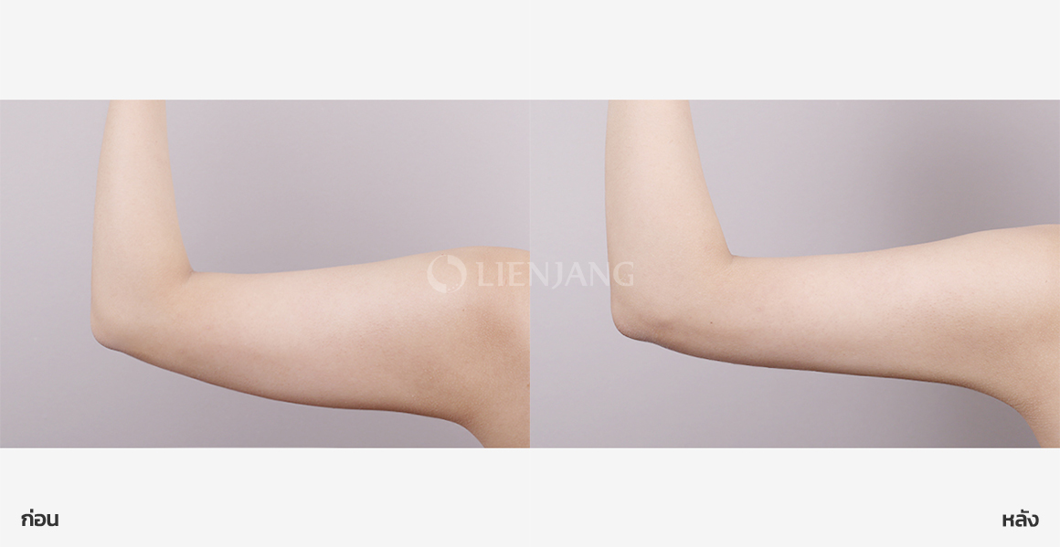 Arm liposuction · 3 weeks after surgery — Lienjang case #161