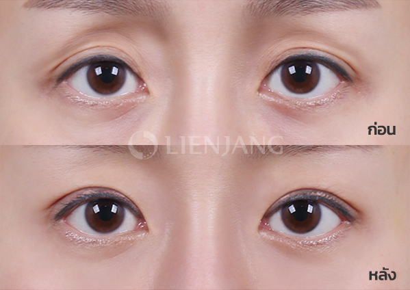 Upper-eyelid fat grafting + Incisional double eyelid · 2 months after surgery — Lienjang case #002