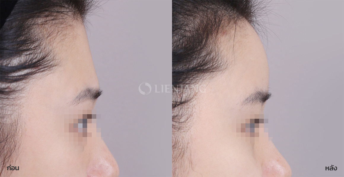Facial fat grafting · 1 month after surgery — Lienjang case #116