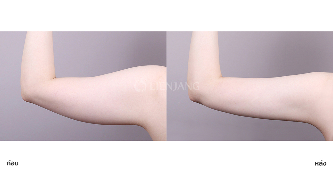 Arm liposuction · 3 weeks after surgery — Lienjang case #162
