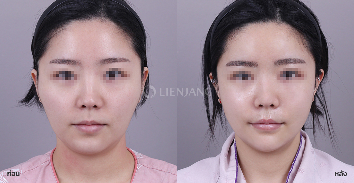 ศัลยกรรมโหนกแก้ม · หลังผ่าตัด 1 เดือน — Lienjang case #105