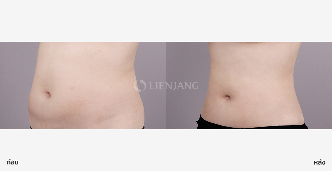 Abdominal liposuction · 1 month after surgery — Lienjang case #163