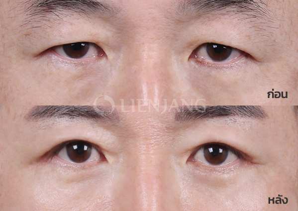 Upper blepharoplasty + Lower blepharoplasty Plus + Lateral canthopexy · 3 months after surgery — Lienjang case #003