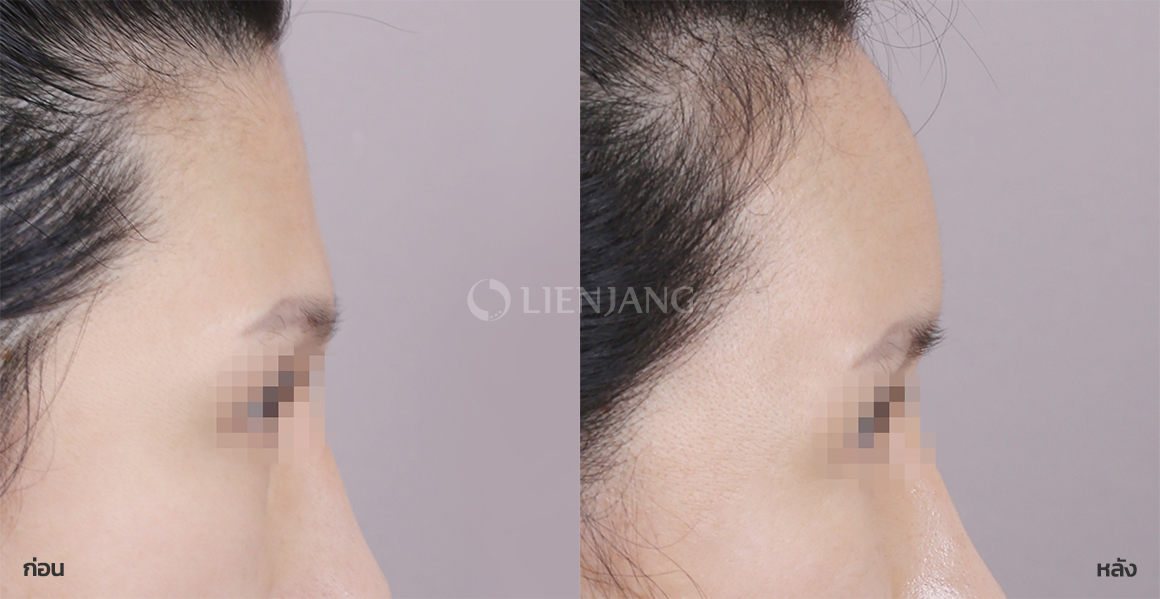 Facial fat grafting · 1 month after surgery — Lienjang case #117