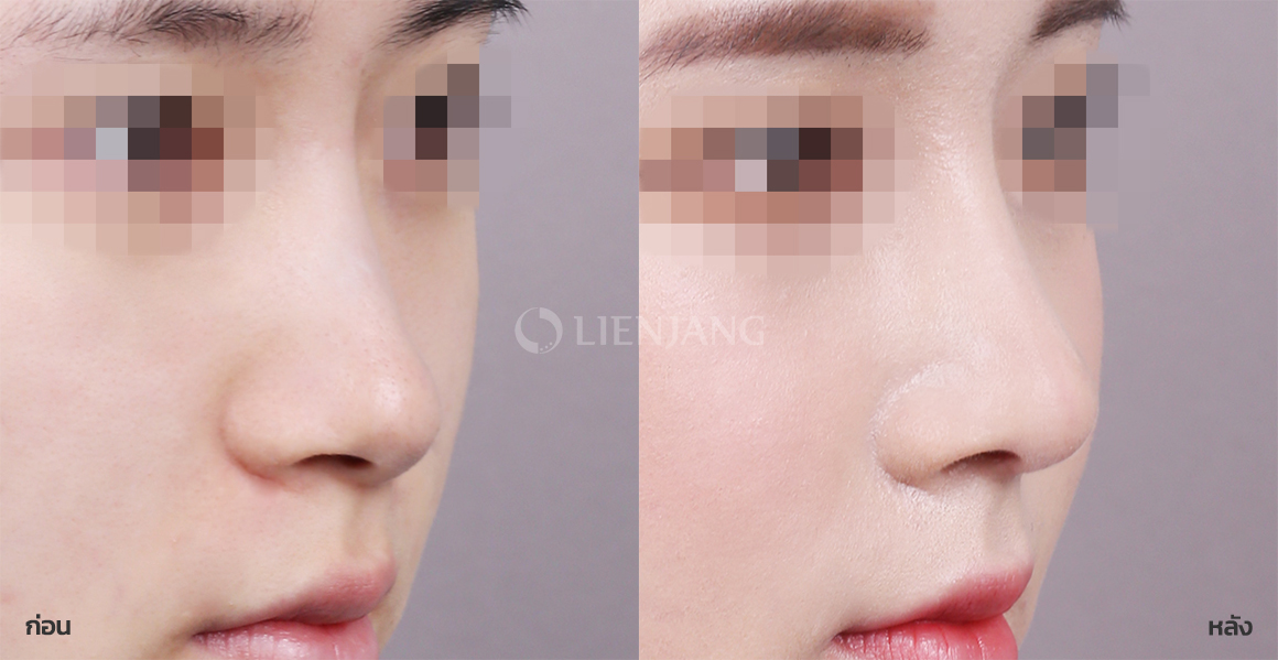 เสริมจมูก (สันจมูก + ปลายจมูก) · หลังผ่าตัด 1 สัปดาห์ — Lienjang case #066