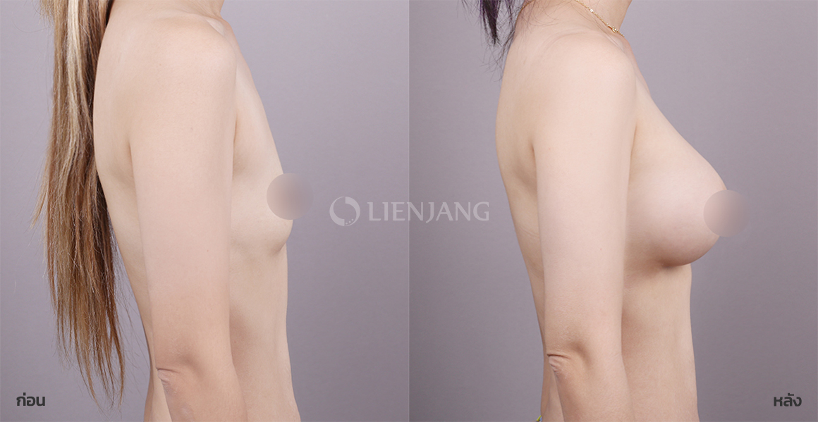 Breast augmentation · 5 months after surgery — Lienjang case #131