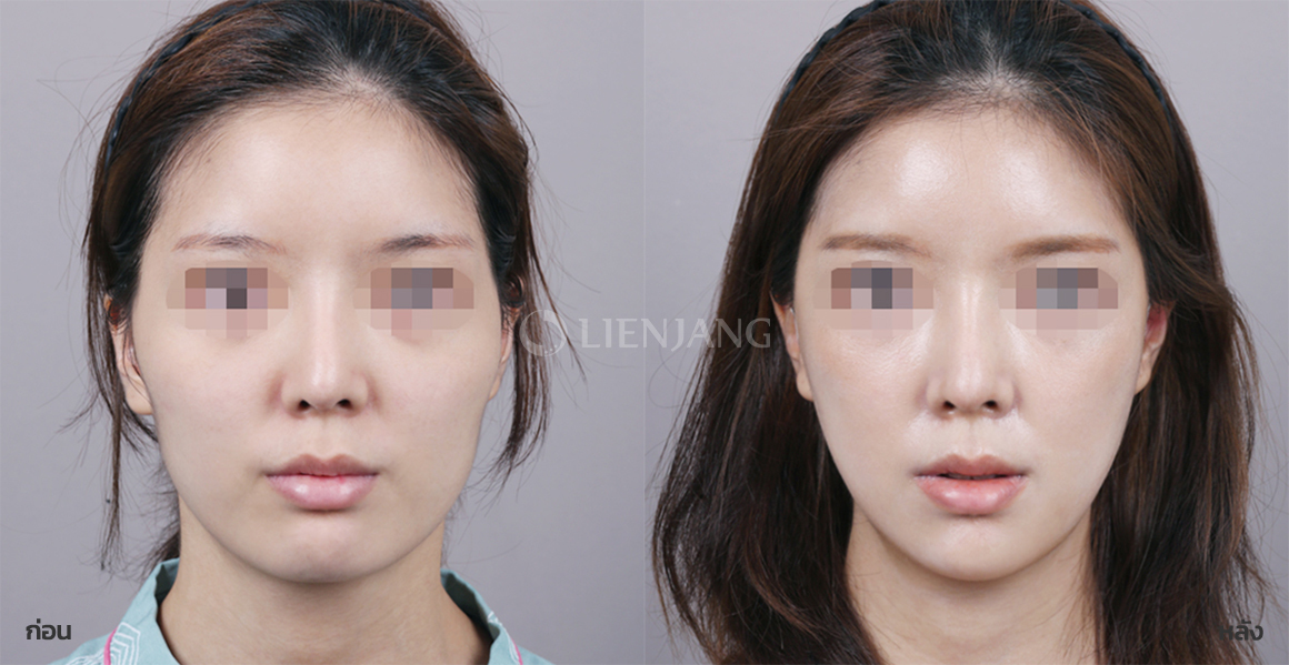 Cheekbone surgery + Square-jaw reduction · 1 week after surgery — Lienjang case #106
