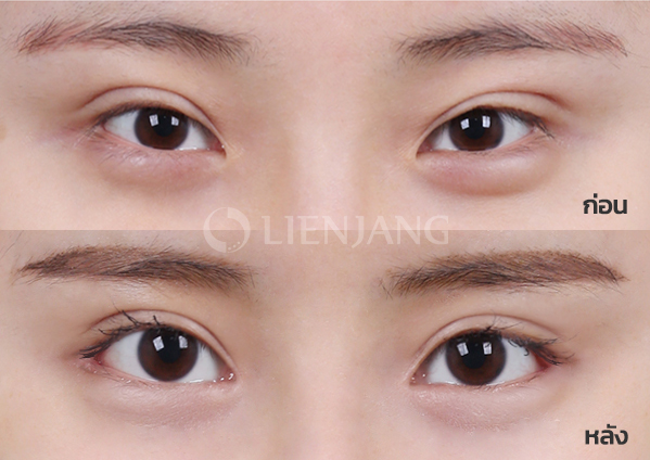 Ptosis correction + Dual epicanthoplasty + Epicanthoplasty · 1 month after surgery — Lienjang case #004