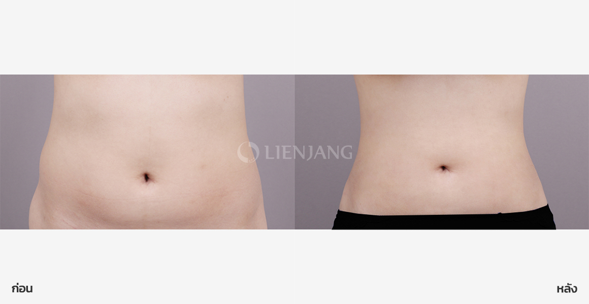 Abdominal liposuction · 1 month after surgery — Lienjang case #164