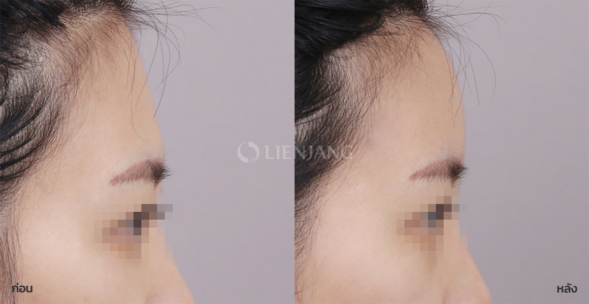 Facial fat grafting · 1 month after surgery — Lienjang case #118