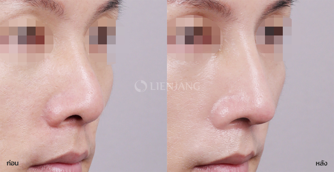 เสริมจมูก (สันจมูก + ปลายจมูก) · หลังผ่าตัด 1 เดือน — Lienjang case #067