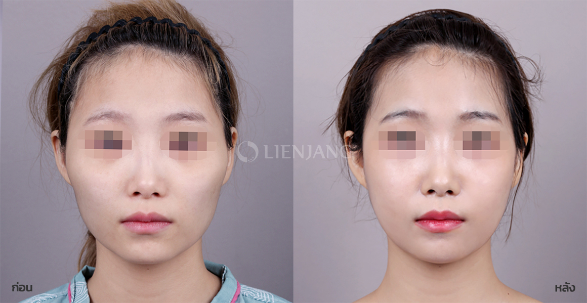 Cheekbone surgery · 1 month after surgery — Lienjang case #107
