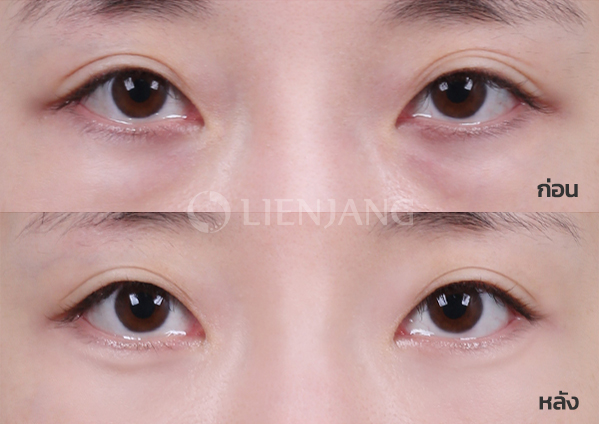 Under-eye fat repositioning · 1 month after surgery — Lienjang case #005
