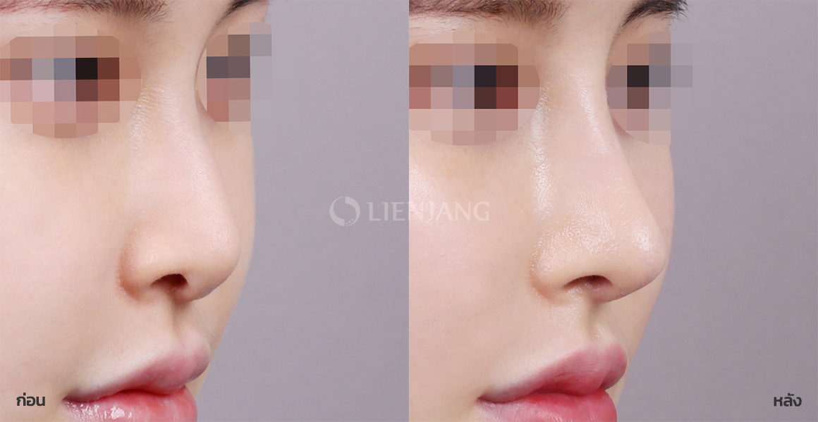 Rhinoplasty: bridge + tip · 1 month after surgery — Lienjang case #068