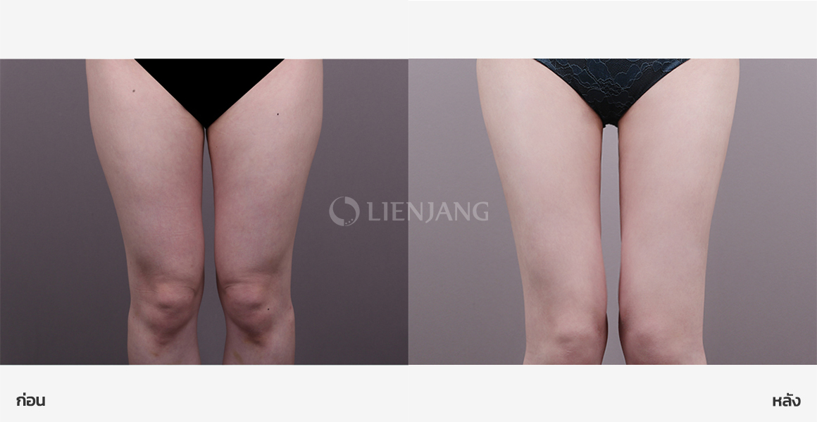 Thigh liposuction · 3 months after surgery — Lienjang case #165