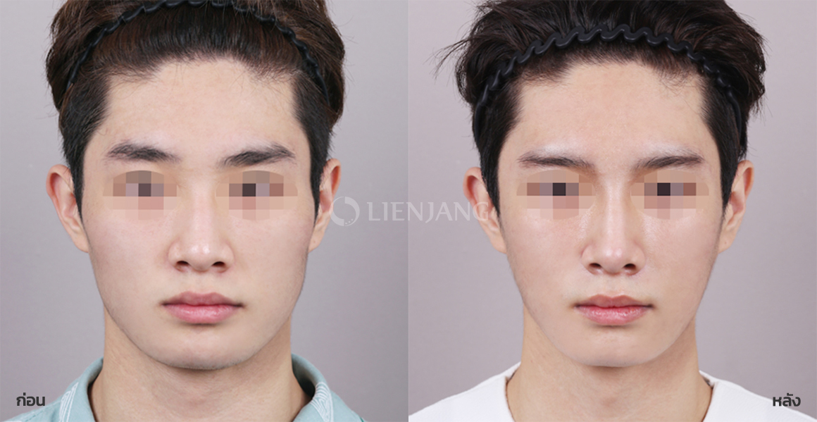 Cheekbone surgery · 1 month after surgery — Lienjang case #108
