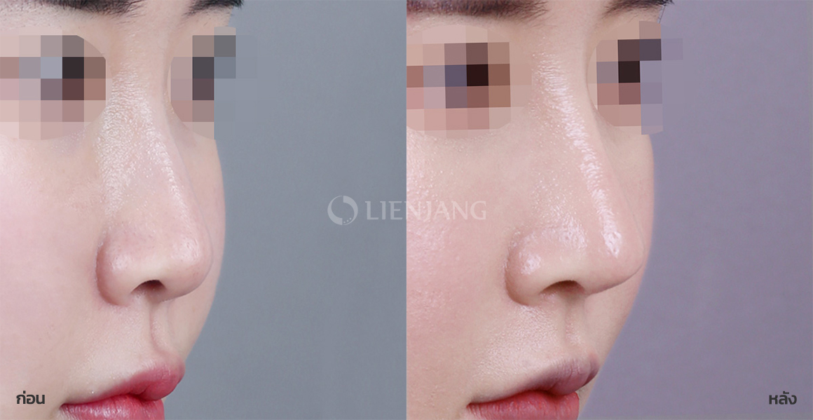 Rhinoplasty: bridge + tip · 1 month after surgery — Lienjang case #069