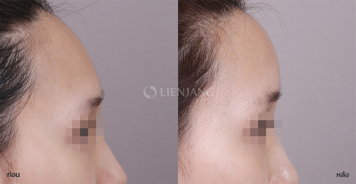 PicoCell facial fat grafting · 1 month after surgery — Lienjang case #120