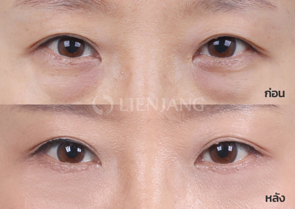 Lower blepharoplasty Plus + Lateral canthopexy · 1 month after surgery — Lienjang case #006