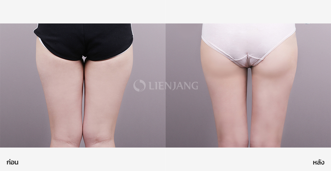 Thigh liposuction (Chanel line) · 3 weeks after surgery — Lienjang case #166