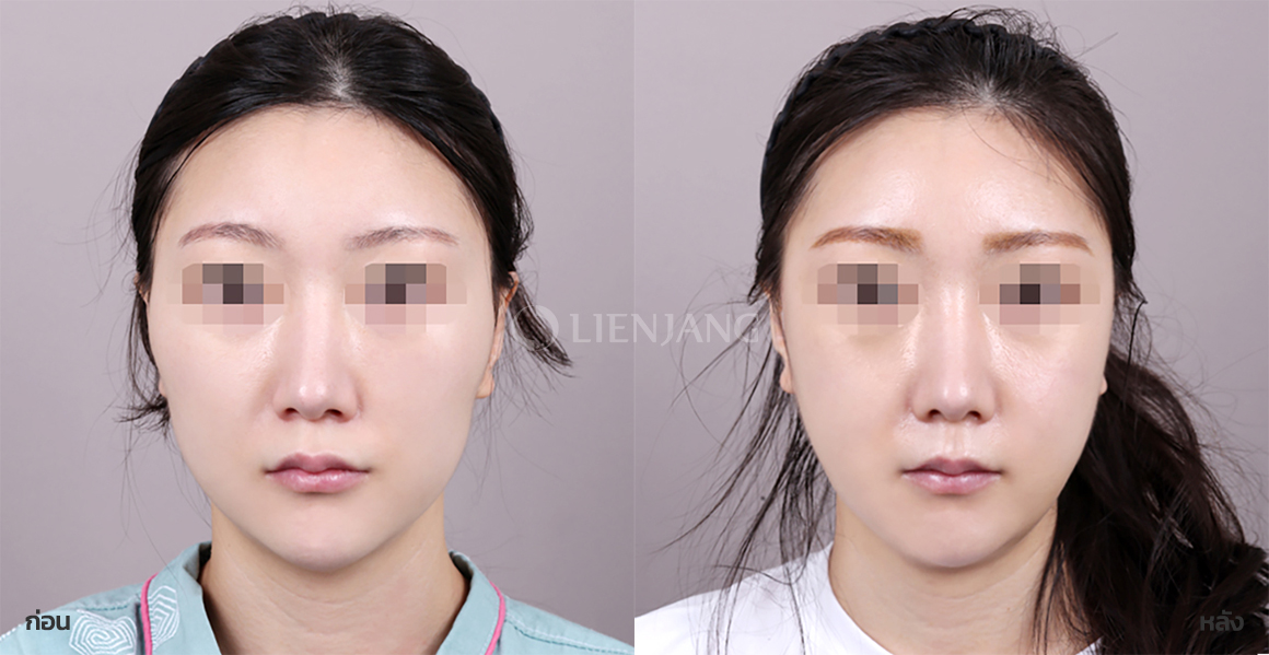 Cheekbone surgery · 1 month after surgery — Lienjang case #109