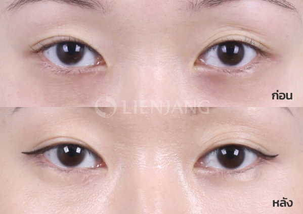 Under-eye fat repositioning · 4 months after surgery — Lienjang case #007