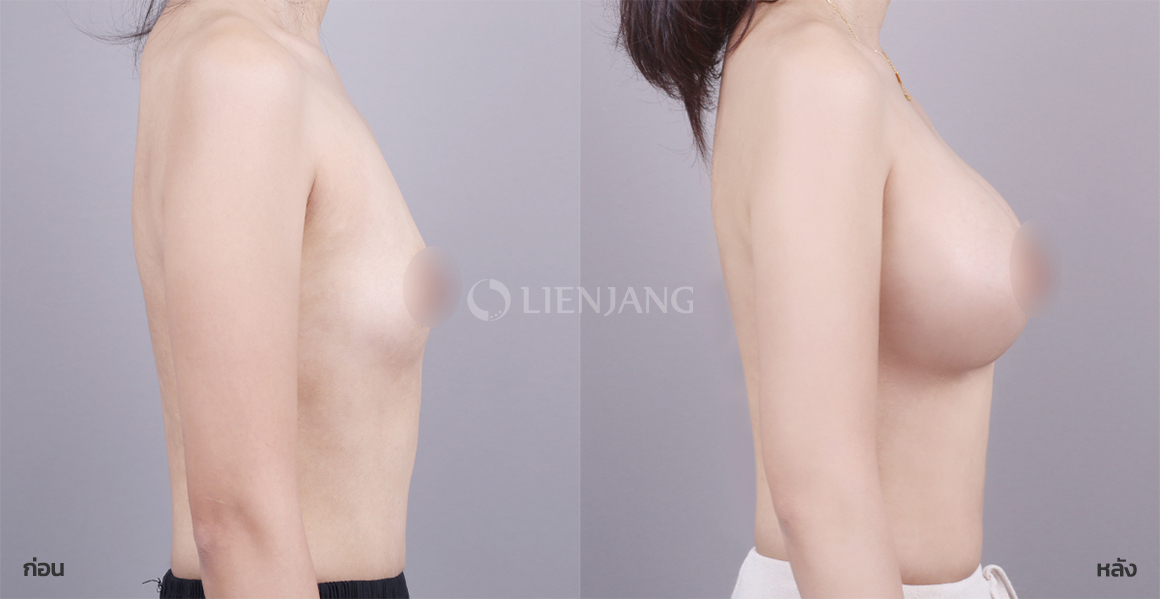 Breast augmentation (Mentor) · 6 months after surgery — Lienjang case #134