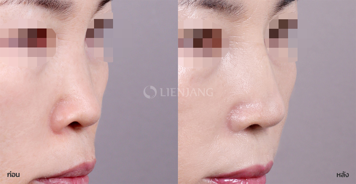 Rhinoplasty: bridge + tip + Alar reduction · 1 month after surgery — Lienjang case #070