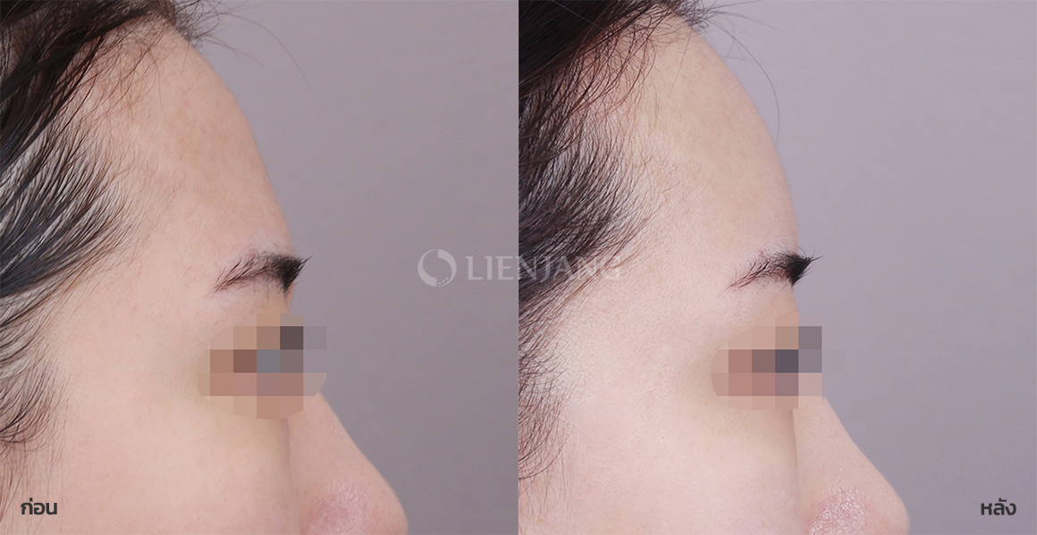 PicoCell facial fat grafting · 2 weeks after surgery — Lienjang case #121