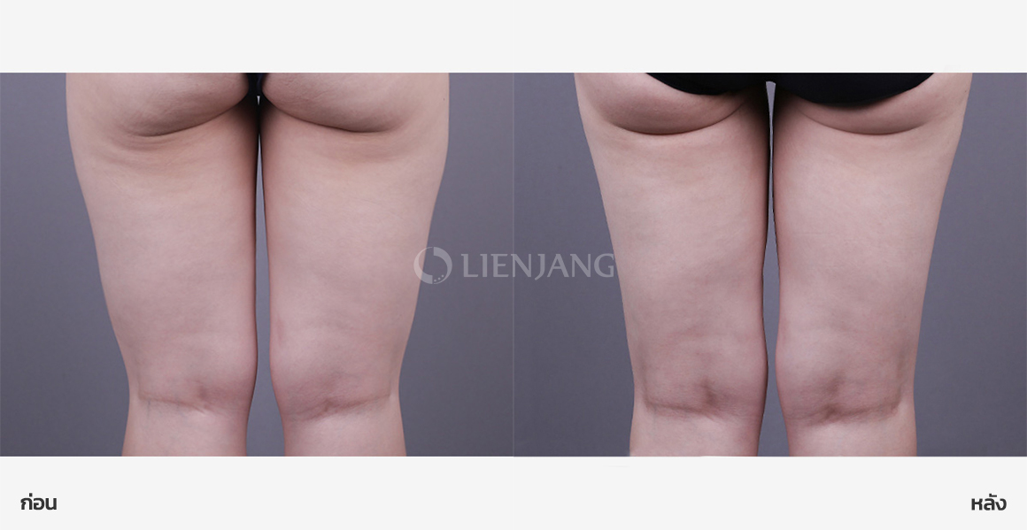Thigh liposuction (Chanel line) · 2 months after surgery — Lienjang case #167