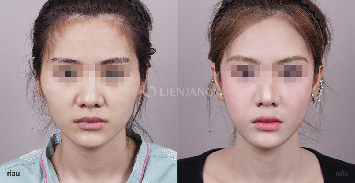 Cheekbone surgery · 2 weeks after surgery — Lienjang case #110