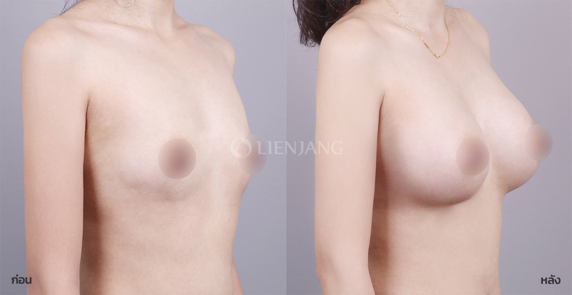 Breast augmentation (Mentor) · 6 months after surgery — Lienjang case #135