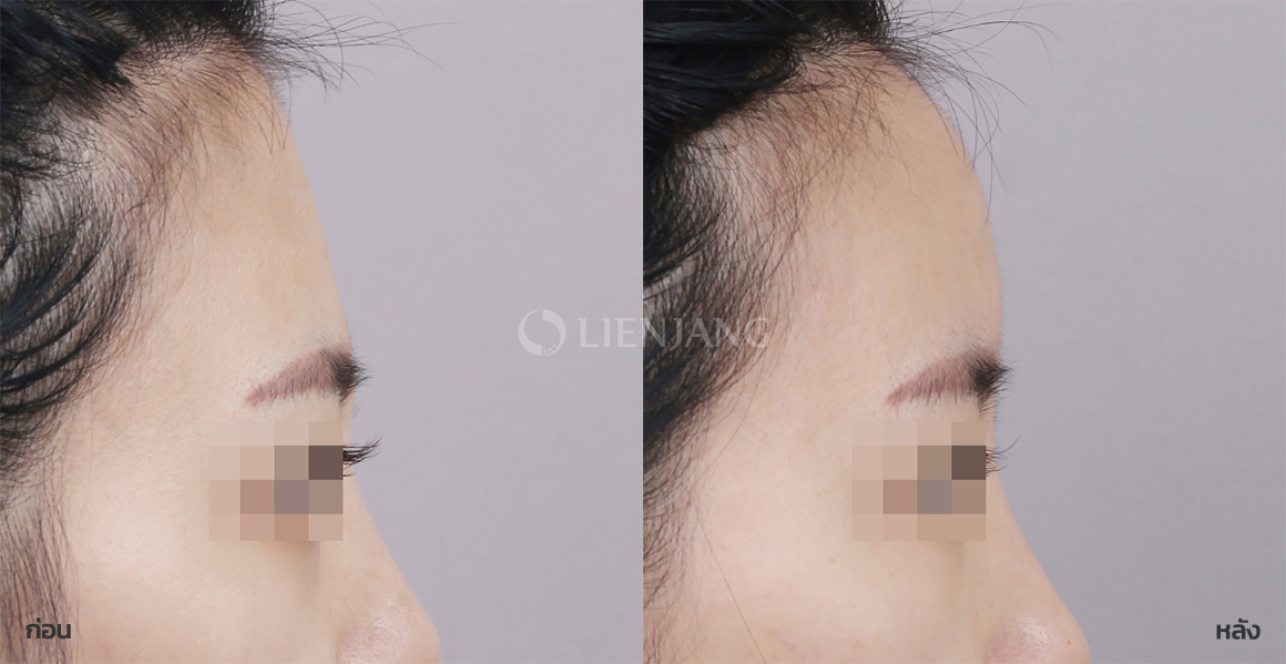 Forehead fat grafting · 1 month after surgery — Lienjang case #122