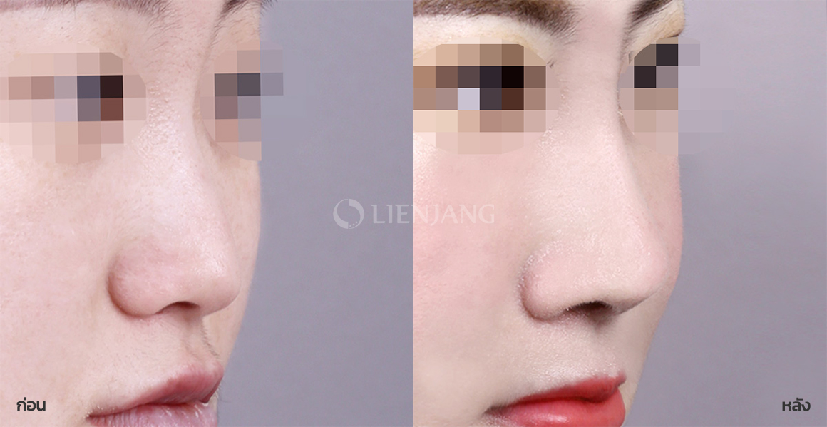 Alar reduction + Bridge augmentation · 5 months after surgery — Lienjang case #071