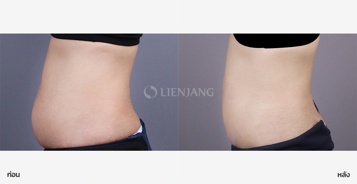 Lower-abdomen liposuction · 1 year after surgery — Lienjang case #168