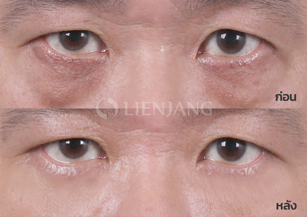 Lower blepharoplasty · 1 week after surgery — Lienjang case #008