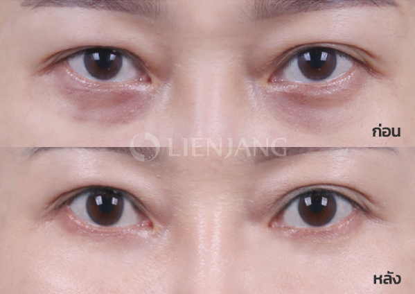 Under-eye fat repositioning · 4 months after surgery — Lienjang case #009