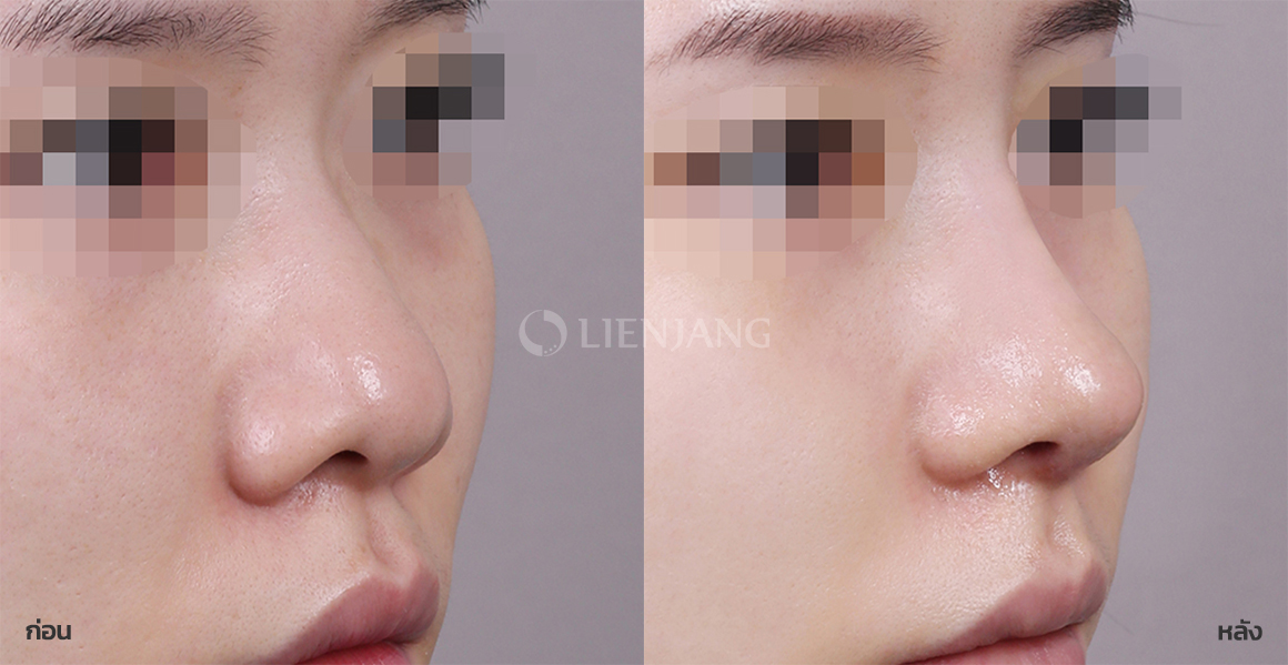 Rhinoplasty: bridge + tip · 1 week after surgery — Lienjang case #072
