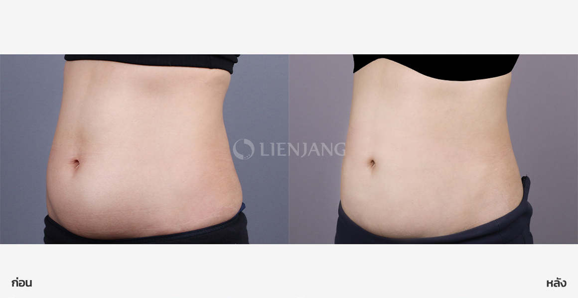Lower-abdomen liposuction · 1 year after surgery — Lienjang case #169