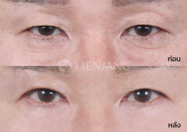 Upper blepharoplasty Plus + Lower blepharoplasty Plus + Lateral canthopexy · 6 months after surgery — Lienjang case #010