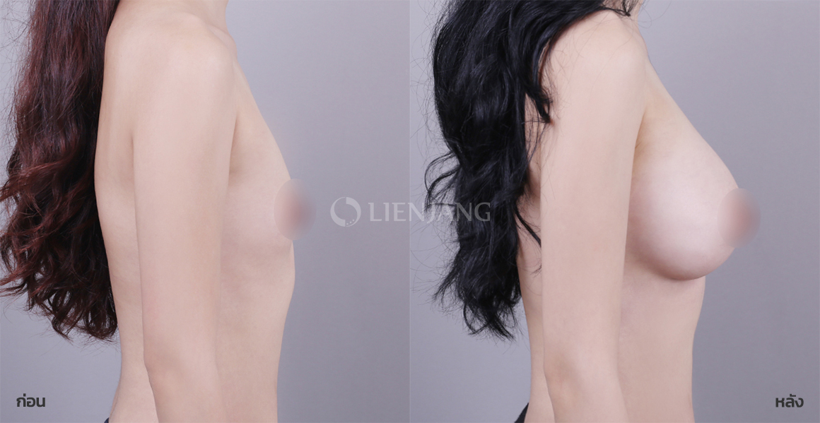 Breast augmentation (Sebbin) · 2 months after surgery — Lienjang case #137