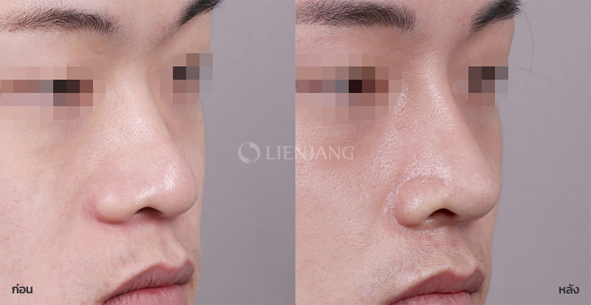 Rhinoplasty: bridge + tip · 1 week after surgery — Lienjang case #073