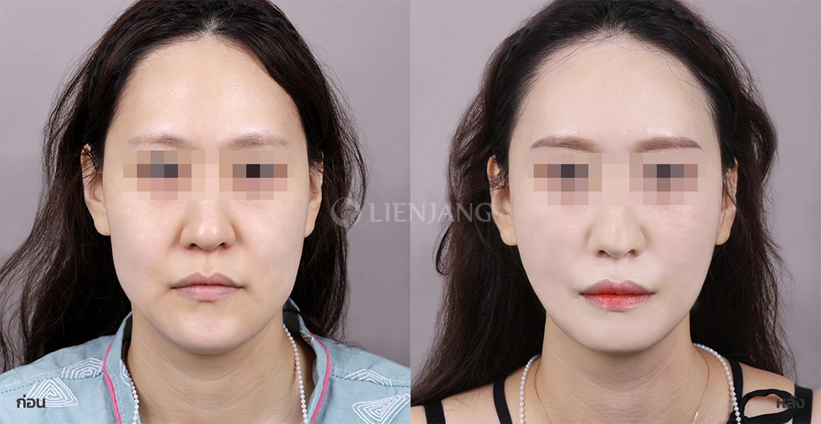 Total V-line contouring · 1 month after surgery — Lienjang case #111