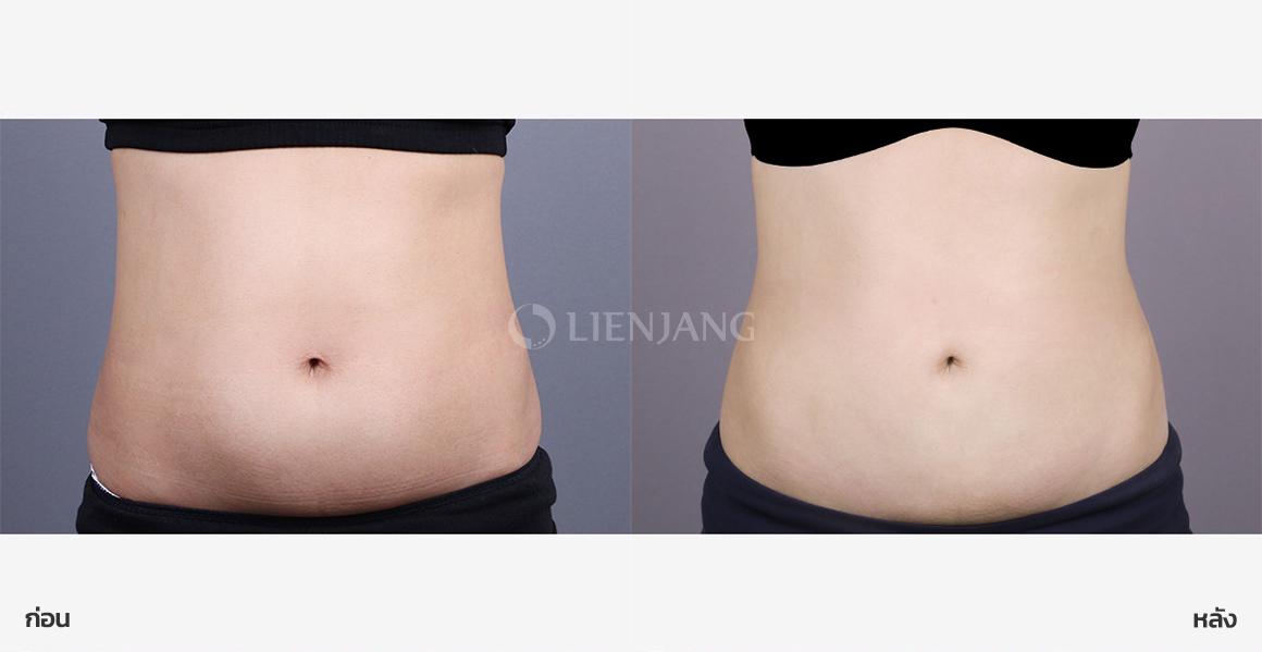 Lower-abdomen liposuction · 1 year after surgery — Lienjang case #170