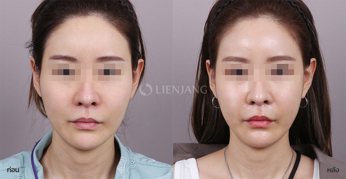 Cheekbone surgery · 1 month after surgery — Lienjang case #112